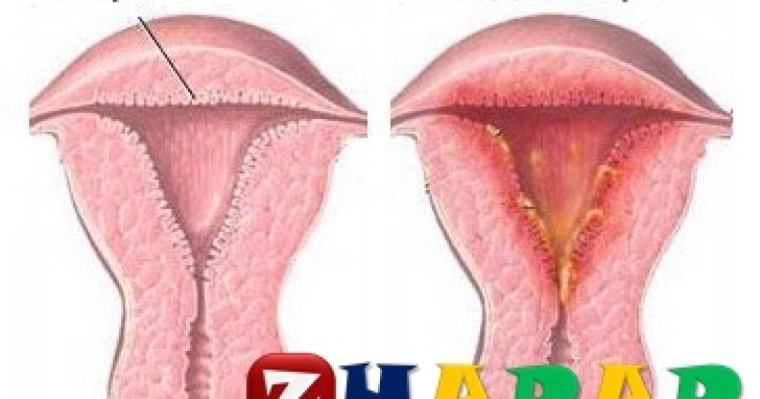 Эндометрит