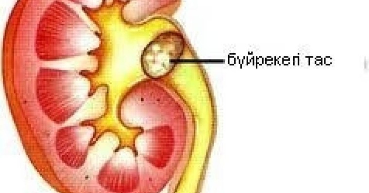 Бүйре қуық жолдарындағы тастан құтылу