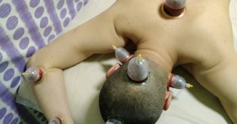 қан алдырудың пайдасы, бастан қан алдыру, оразада қан алдыруға бола ма