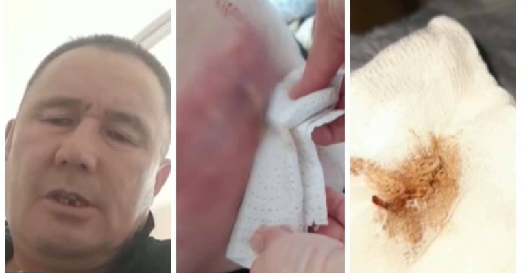 Қарағанды облысы тұрғыны отадан кейін ішінде қалып қойған дәкемен бір жыл жүрген