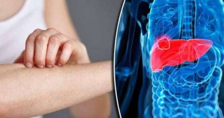 研究显示含铁量高的人更容易感染肝病