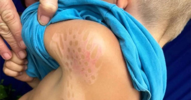 "Үтіктің іздері қалған": Талдықорғанда полиция арнайы балалар орталығындағы азаптау фактілерінен кейін тергеу бастады