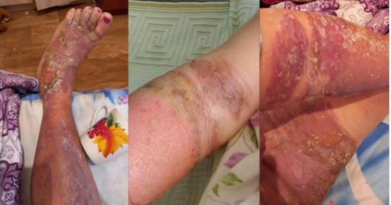 "Жедел жәрдем шақыруға рұқсат бермеген". Ақтөбеде ер адам әйелінің үстіне қайнаған су құйып жіберген