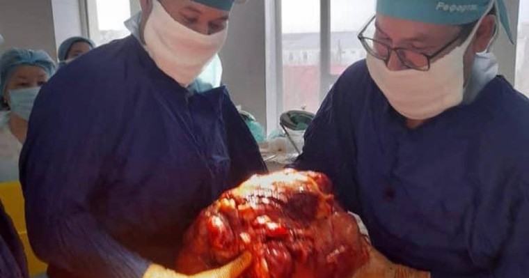 Атырау тұрғынынан дәрігерлер 15 келі ісік алды