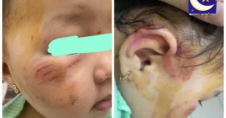 Алматыдағы балабақшаның бірінде бір жарым жастағы қызды ұрып-соққан