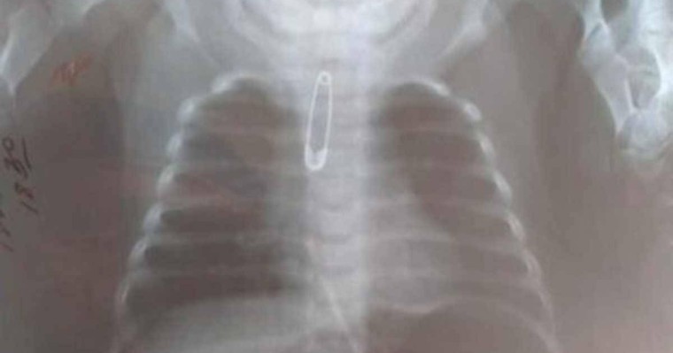 Шымкентте үш айлық баланың ішінен түйреуіш шықты