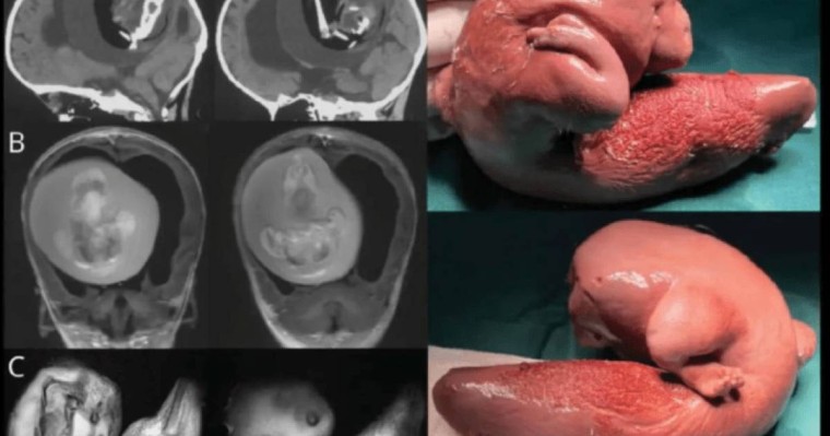 Қытайда бір жасар қыздың миынан егізінің ұрығы анықталды