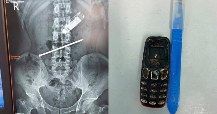 Дәрігерлер телефон жұтып қойған қызылордалық ер адамды құтқарып қалды