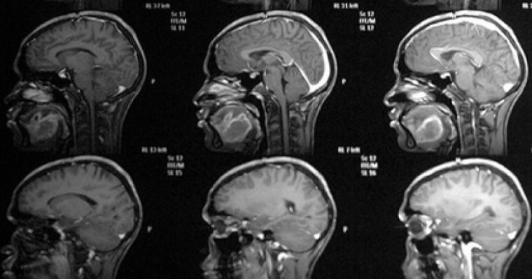 Онколог ми қатерлі ісігінің алғашқы белгілерін атады