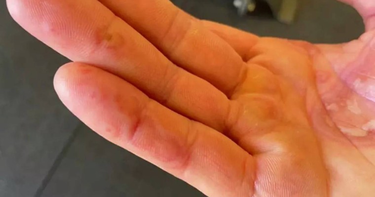 Қолдағы қызыл түйнек: Covid-19-дың жаңа симптомы анықталды