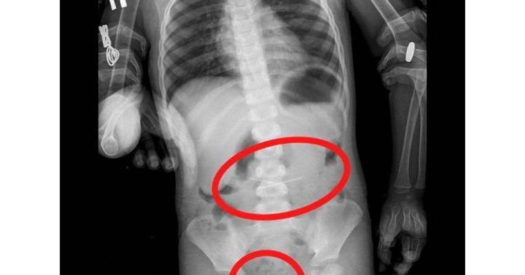 Үш жасар бала төрт тігін инесін жұтып қойған