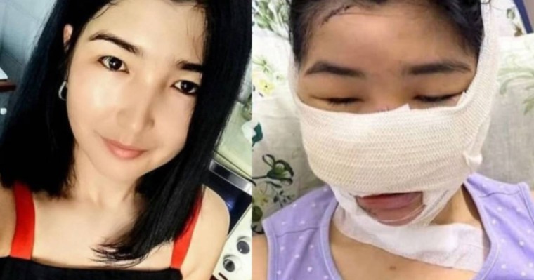 Мұрны мен құлағын кескен: күйеуінен зардап шеккен келіншекке ота жасалды