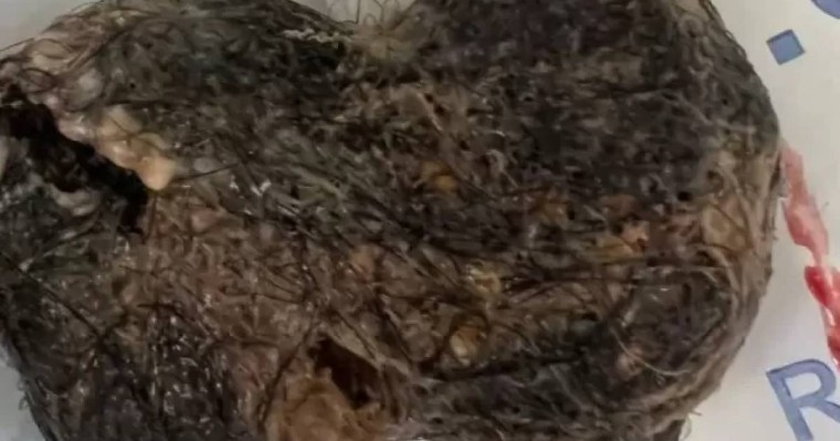 Жамбыл облысында бойжеткеннің асқазанынан 30 сантиметрлік тығыз шаш түйіні шықты