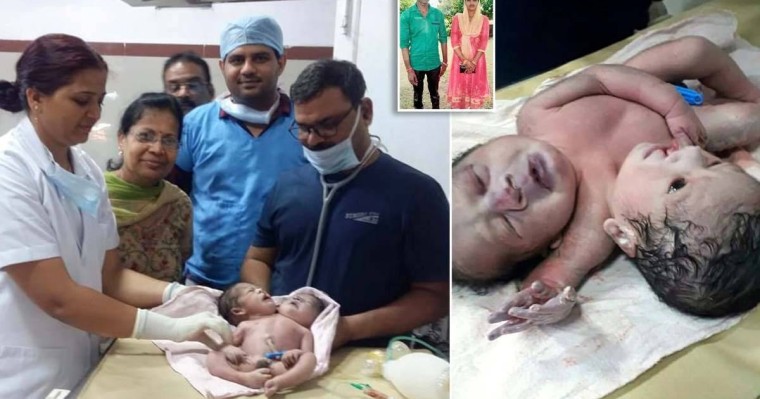 Үндістанда екі басты дені сау бала өмірге келді
