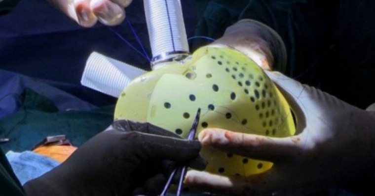 Алматыда ер адамға жасанды жүрек салынды