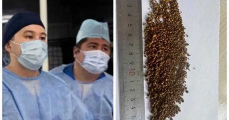 Алматылық дәрігерлер науқастың өт қабынан 5 499 тас алған