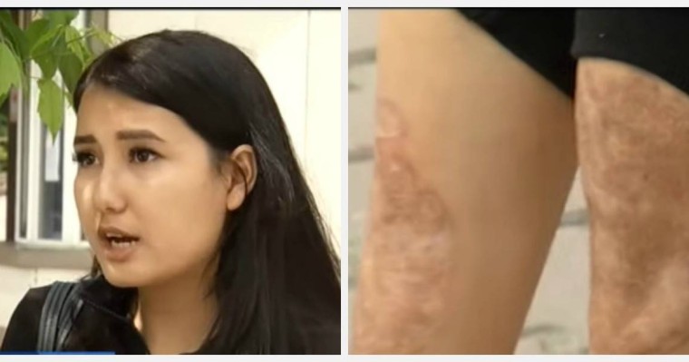 Алматы облысындағы перзентханада ота жасаған әйелдің аяғын күйдіріп жіберген - Қазақстан жаңалықтары