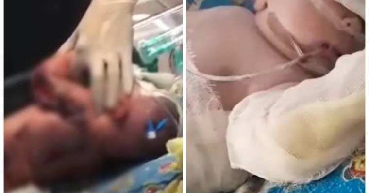 Семейдегі перзентханада дәрігерлер жаңа туған нәрестені күйдіріп алған