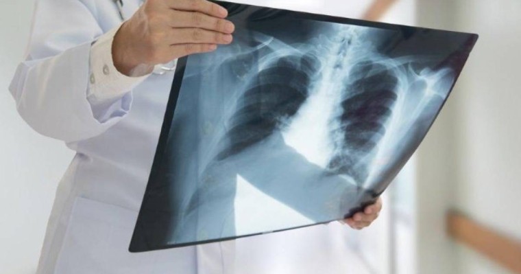 Қазақстанда COVID-19 белгілері бар пневмониямен 158 адам ауырып, 4 науқас көз жұмды