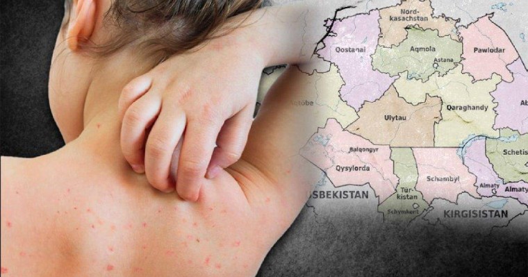 «Ата-аналар балаларына екпе салғызбай отыр»: Қызылша жұқтырғандар саны 30 мыңнан асты
