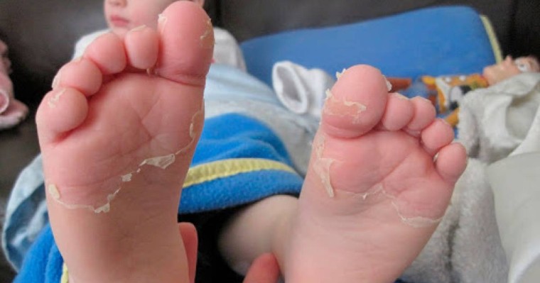 Қазақстанда Кавасаки синдромы бар екі бала көз жұмды