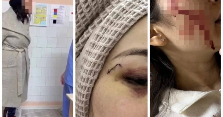 Кеудесін тістеп, шап тұсынан ұрған: Алматыда науқас дәрігерлерге шабуыл жасаған
