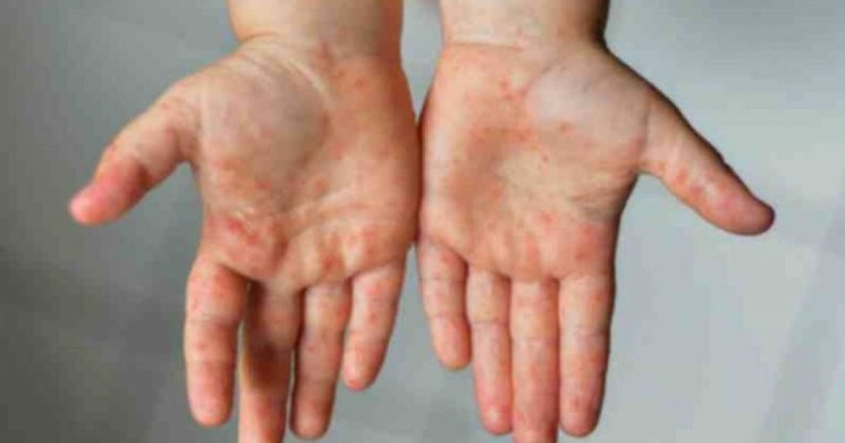 Министрлік Кавасаки синдромына шалдыққан балалар туралы айтты