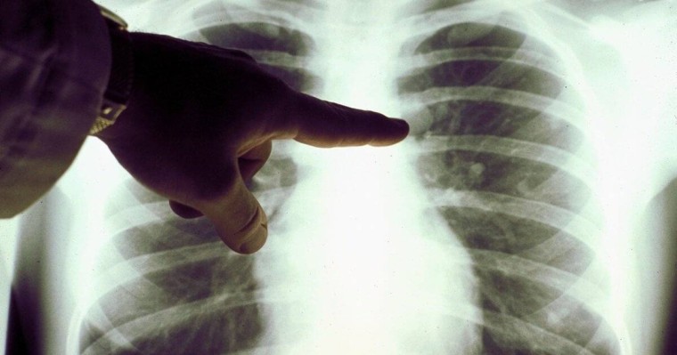 Пневмониядан 4 042 адам қайтыс болды - Жаңа статистика