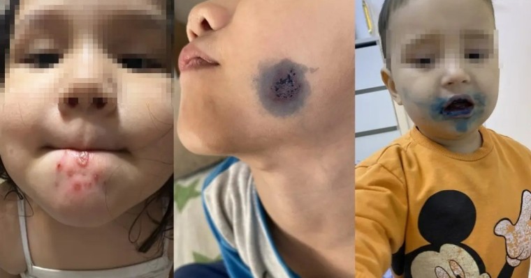 Балалардың беті мен денесіне біртүрлі жара шығып жатыр: беймәлім вирус шыққаны рас па