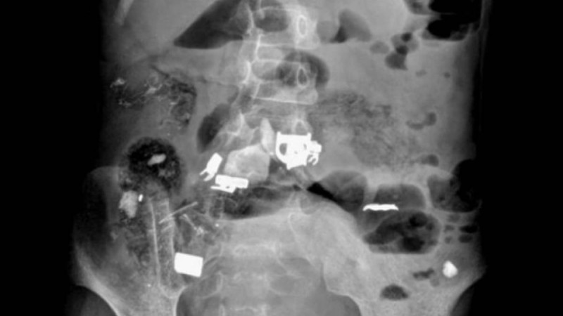 Қыз баланың ішінен шаш, қалам, темір және скточ шықты