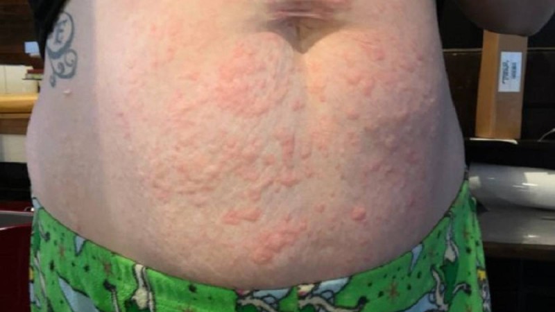 Суықта мүлде жүре алмайды: 26 жастағы бойжеткеннің суыққа аллергиясы бары анықталды - Қазақстан жаңалықтары