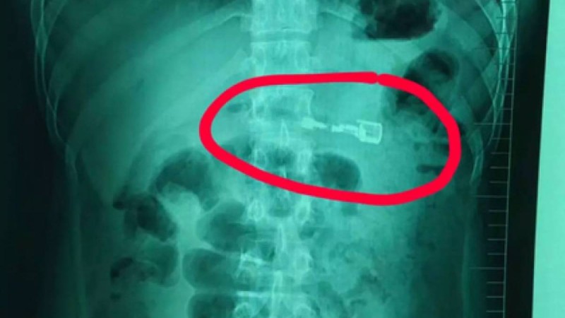 Зажигалка жұтып қойған мас қытайдың асқазаны жарыла жаздады