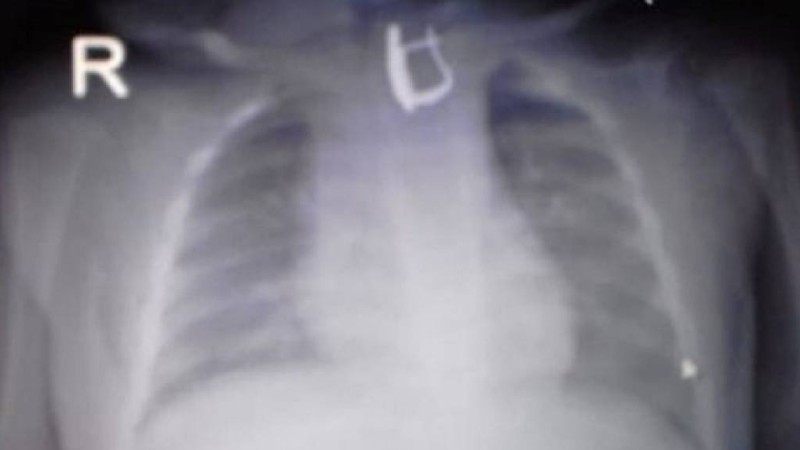 Алматыда 5 айлық бала сырғаны жұтып қойды - Қазақстан жаңалықтары