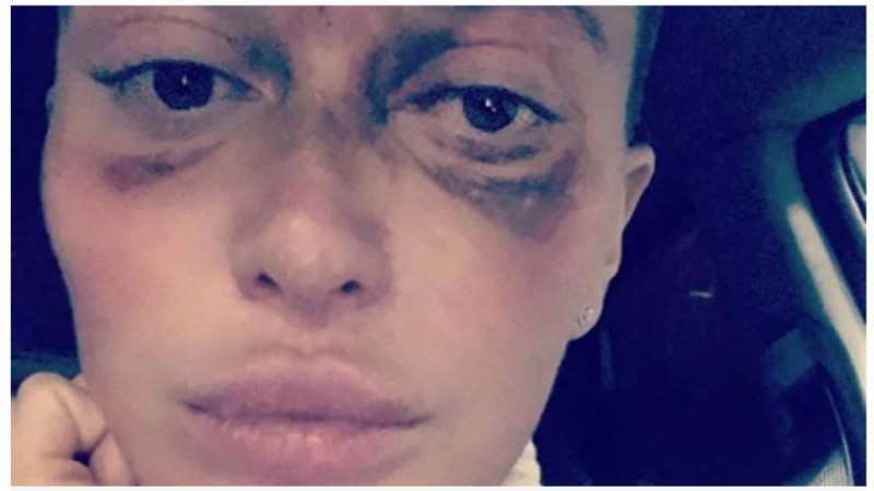 Косметологқа барған арудың бір көзі көрмей қалды