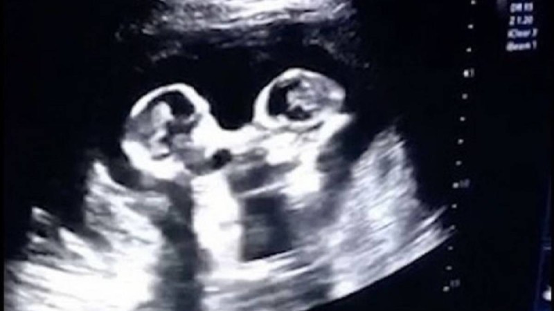 Әкесі құрсақта жатқан егіздердің бір-бірімен төбелескен сәтін көрсетті - Қазақстан жаңалықтары