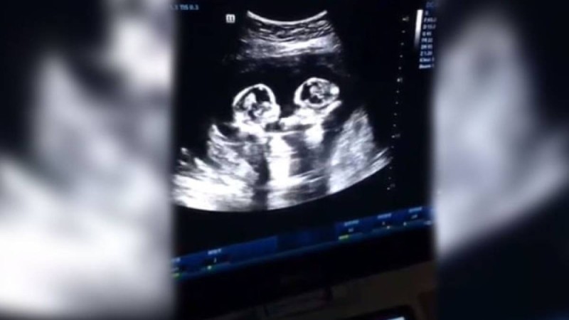 Құрсақта жатқан егіздер "төбелесті" - видео