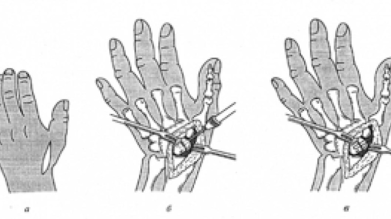 Галеация зақымдануы | KazMedic