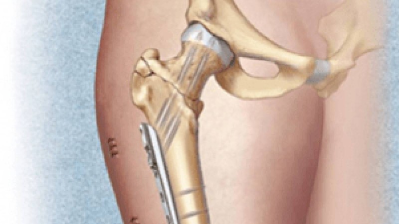 Сан диафизі сынықтары. | KazMedic