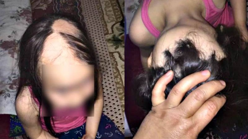 "Суретін көргенде отыра қалып жыладым": Елордалық әйел шашының жартысы түсіп қалған 7 жасар қыз үшін көмек сұрады - Қазақстан жаңалықтары