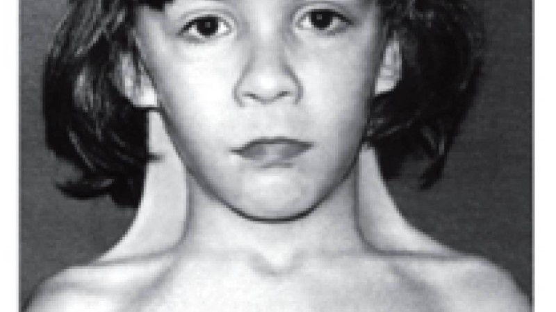 Хромосоманың Х моносомия синдромы (Шершевский-Тернер синдромы, Тернер синдромы,ХО- синдромы)