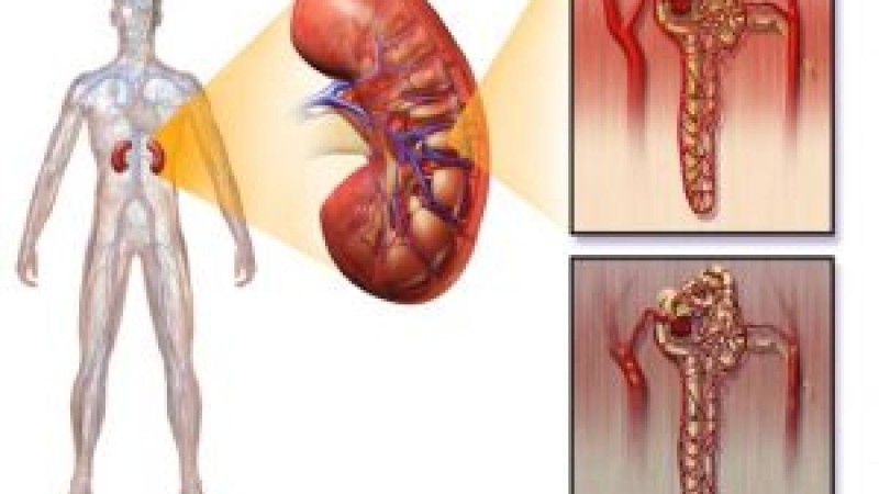 Интерстициальды нефрит