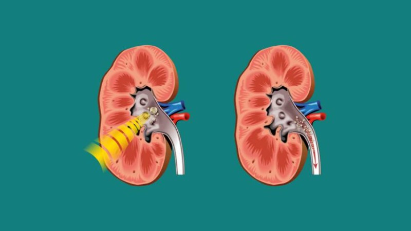 Несеп жолдарының тас ауруы - Денсаулық - Bilim