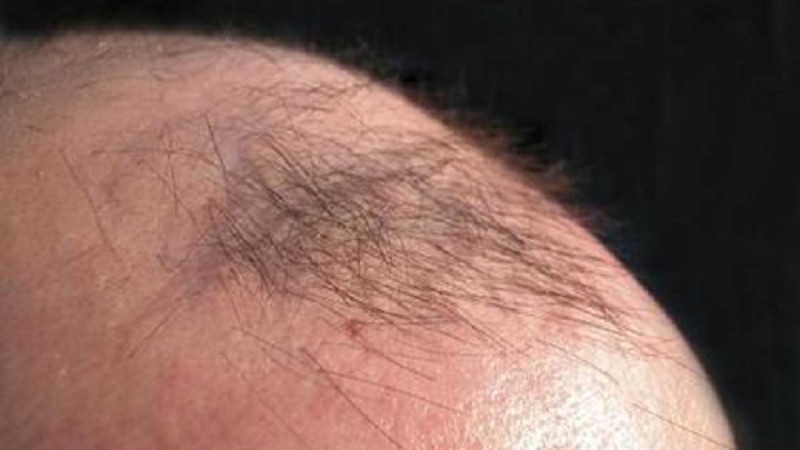 Ер адам басын дихлофоспен жуам деп шашынан айырылды - Қазақстан жаңалықтары