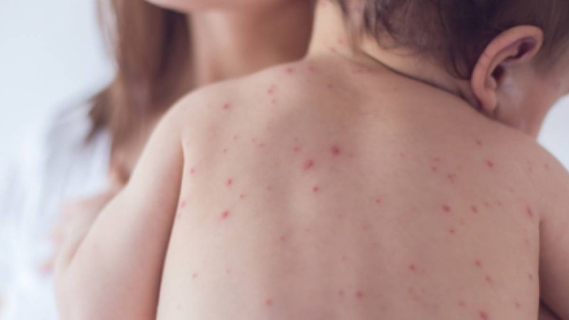 Денсаулық сақтау министрлігі қызылша ауруының өршу себебін түсіндірді