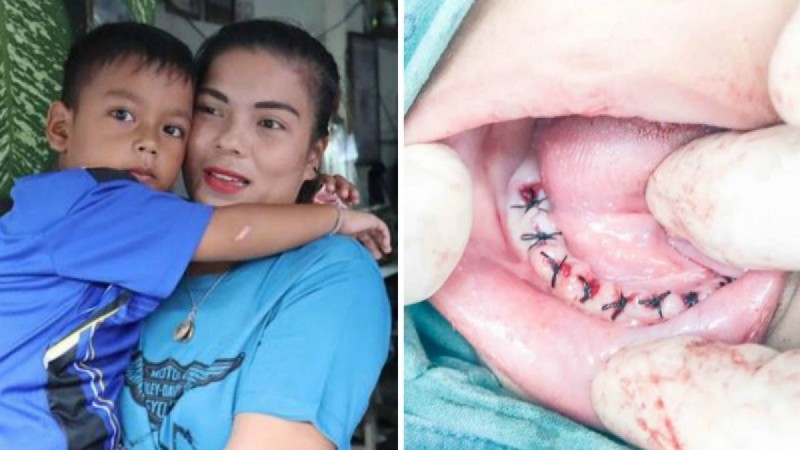 Бәрі шіріп кеткен: Дәрігер 4 жасар баланың 18 тісін жұлып тастауға мәжбүр болды - Қазақстан жаңалықтары
