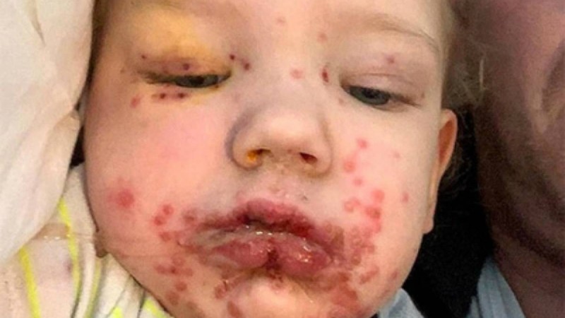 Бетінен сүйгеннің кесірінен нәрестенің үсті-басы жараға толып кетті