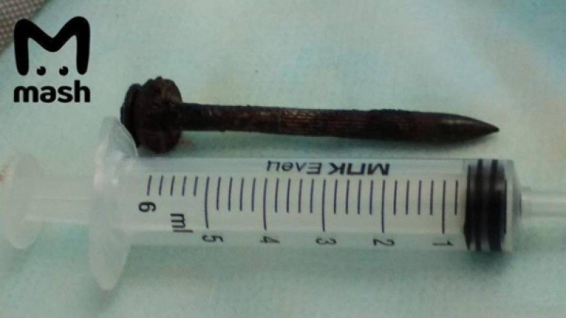 Ер адам басына кіріп кеткен шегемен екі жыл өмір сүрген