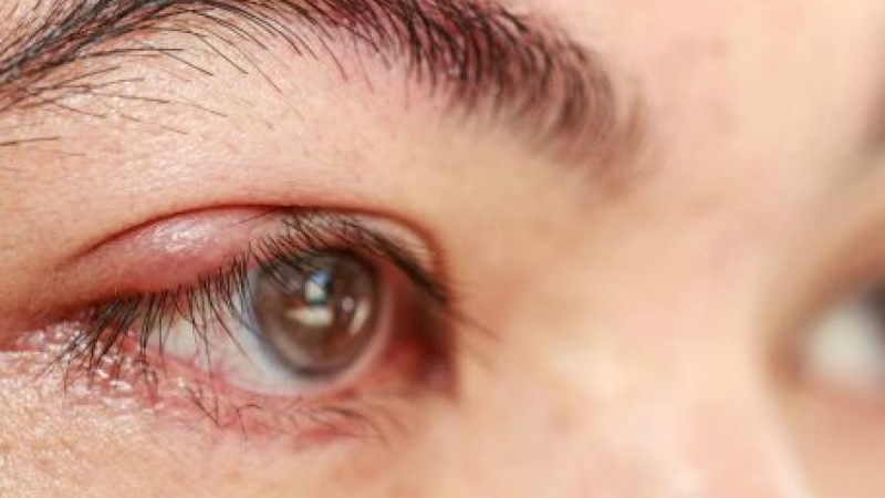 Теріскенді қалай емдеуге болады?