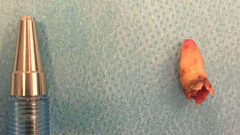 Науқастың мұрнынан тіс өсіп шыққан