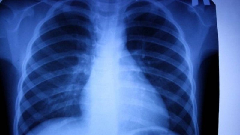 Астанадағы туберкулезге ұшырағандардың көбісі жалға пәтер алып тұратындар